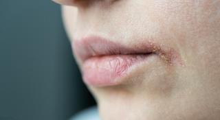 Cold sores – how to know if it's herpes