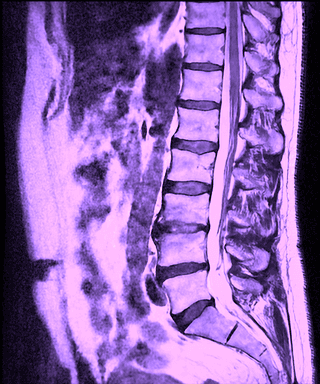 What does an MRI of the lumbar spine show?